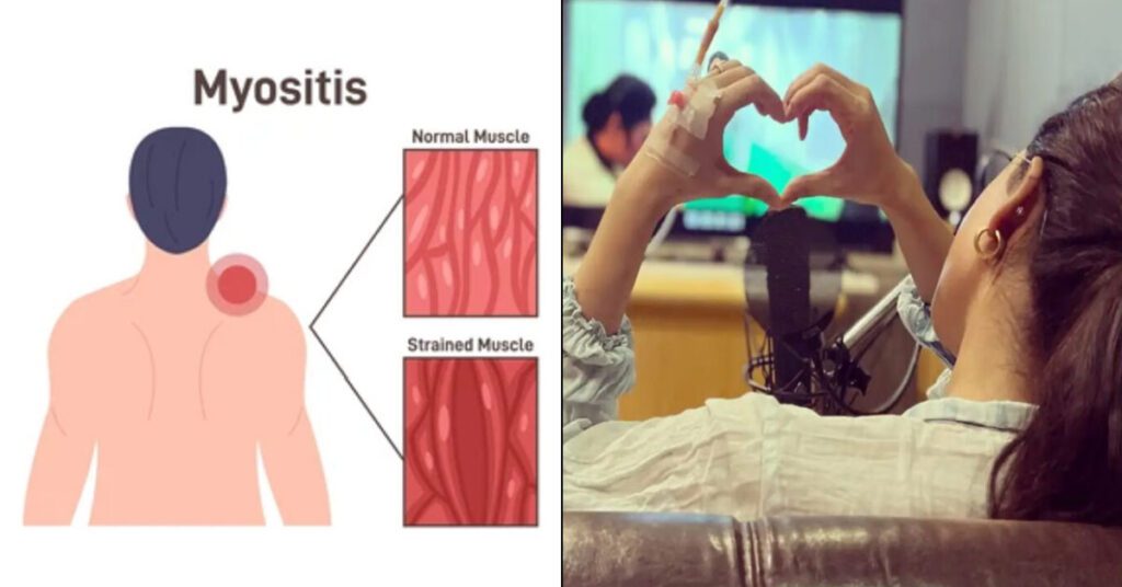 what-is-myositis-in-telugu-manatelangana-news