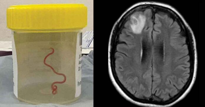 doctor removed worm from brain
